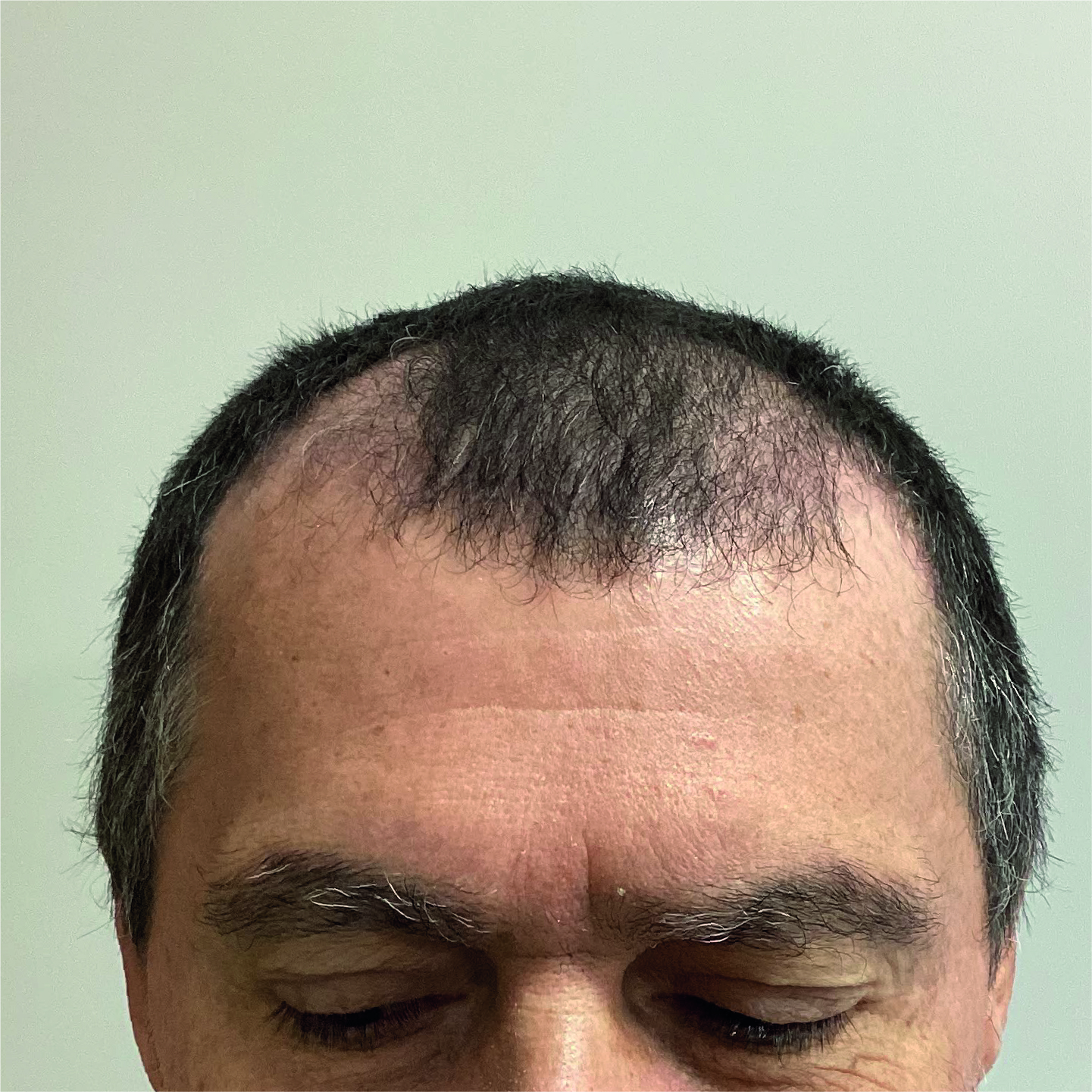Antes