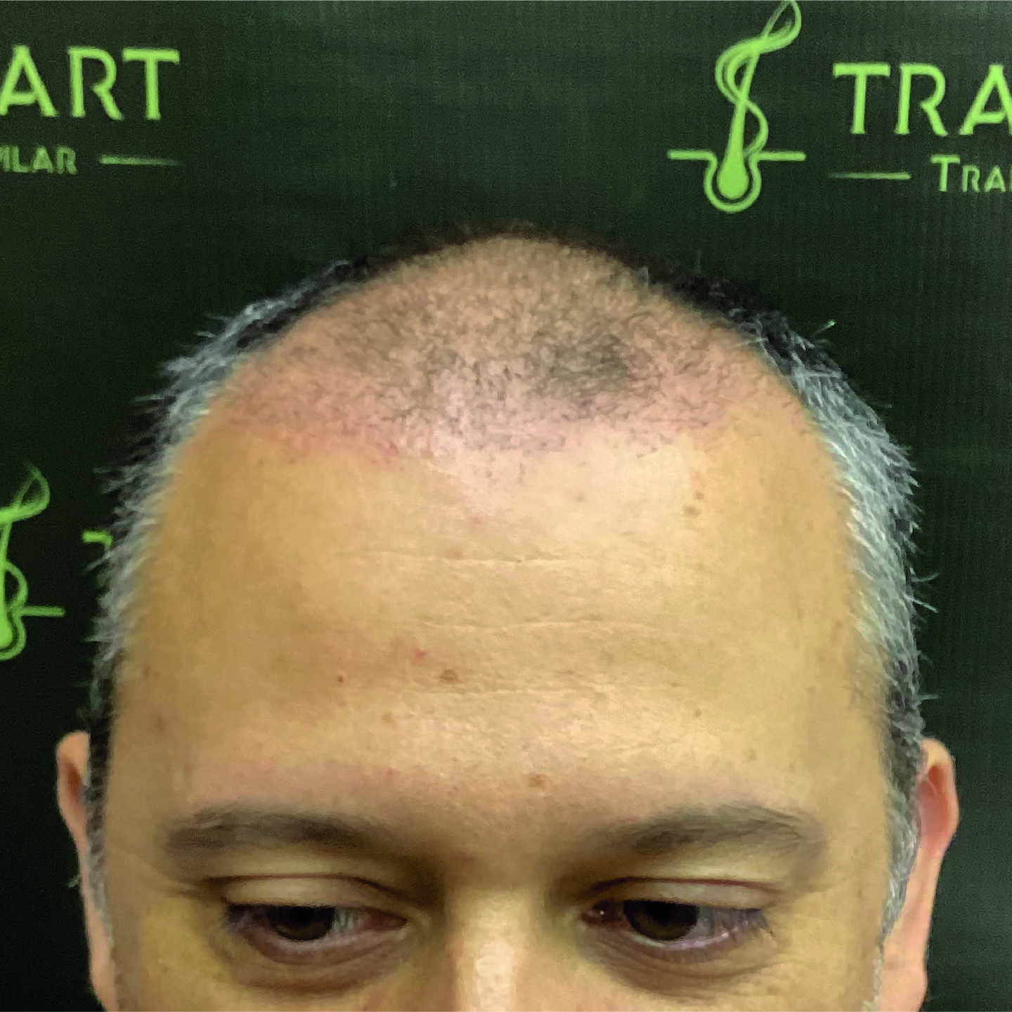 Antes