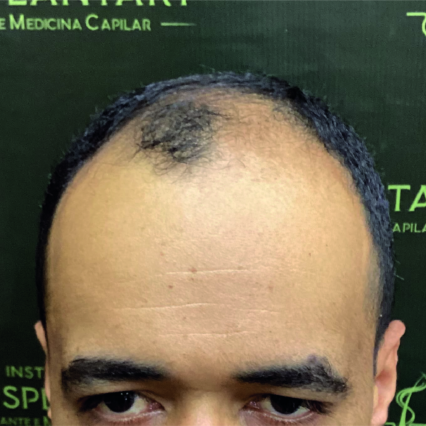 Antes