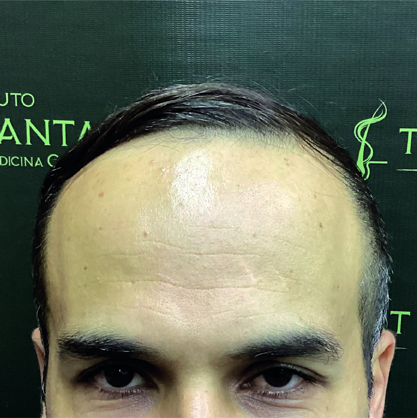 Antes