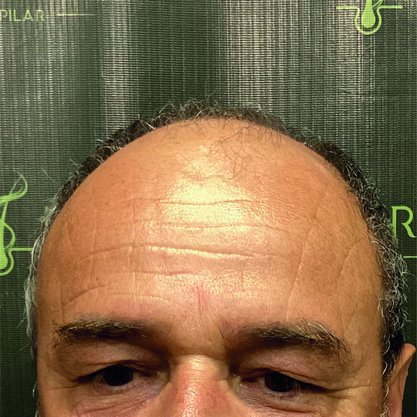 Antes