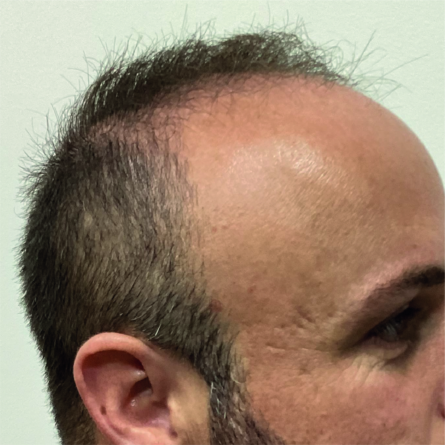 Antes